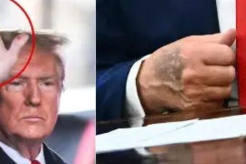 Trump medical, hand marks