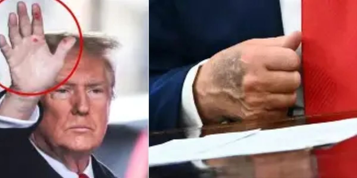 Trump medical, hand marks